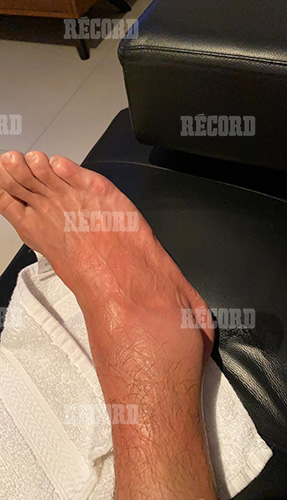 Así luce el pie de Hugo González tras lesión