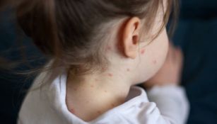Campaña contra el sarampión, arranca en la Ciudad de México ¡Vacuna a los niños!